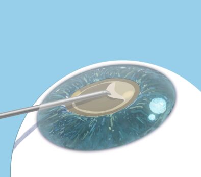 2-copy Ein Chirurg führt eine Nadel in ein Auge ein.