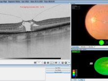 Ein Computerbildschirm, der mehrere Bilder des Auges zeigt. {{brizy_dc_image_alt imageSrc=