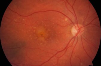 Ein Bild eines Auges mit roten Blutgefäßen. {{brizy_dc_image_alt imageSrc=