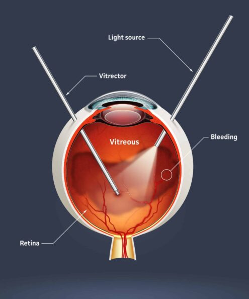 Retinal detachment Ein Diagramm, das die Anatomie des Auges zeigt.